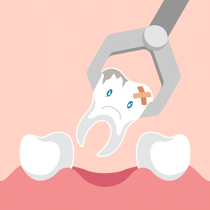 dental extraction