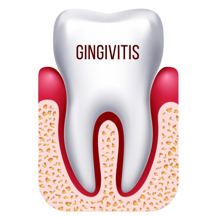 gingivitis