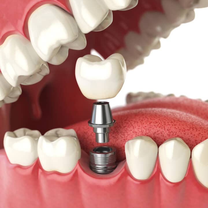 A Closer Look Of A Dental Implant