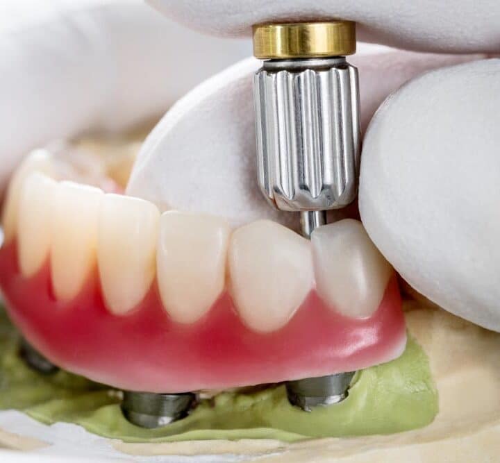 Dental Implant Model