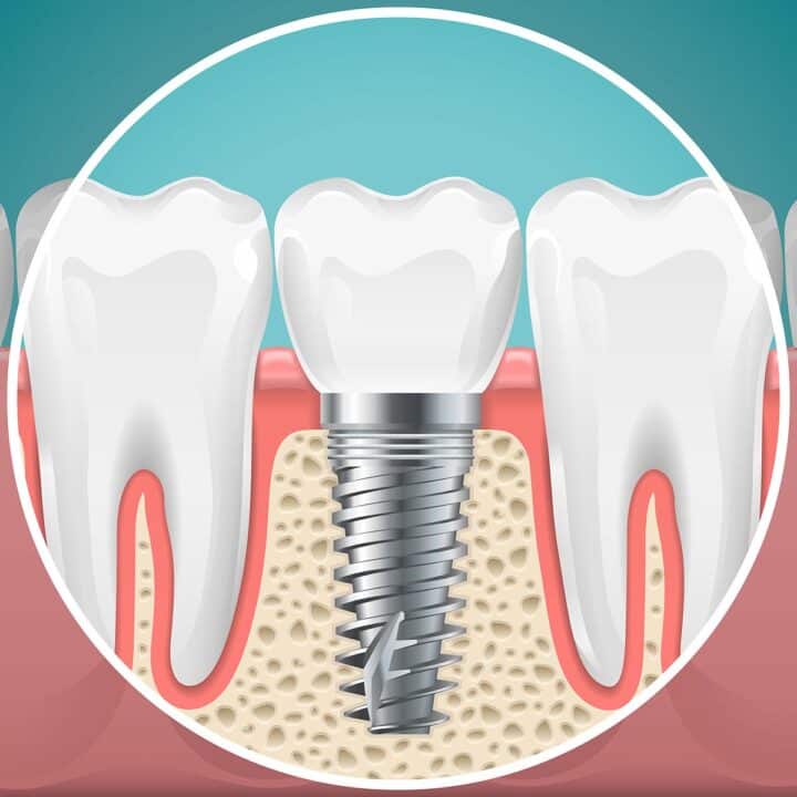 A close-up illustration of a dental implant in a person's mouth