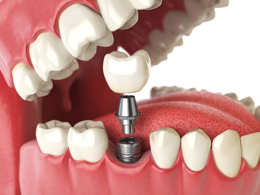 Overcoming The Fear Of Dental Implant Surgery: A Patient’s Guide