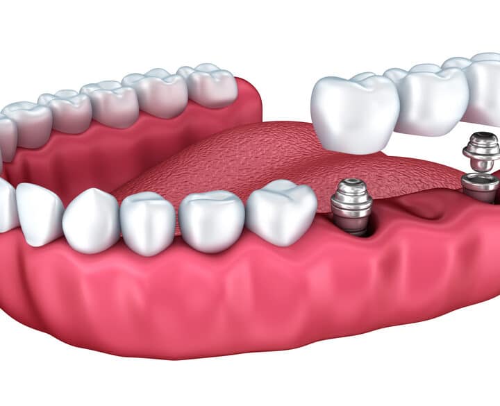 A Multiple Teeth Replacement