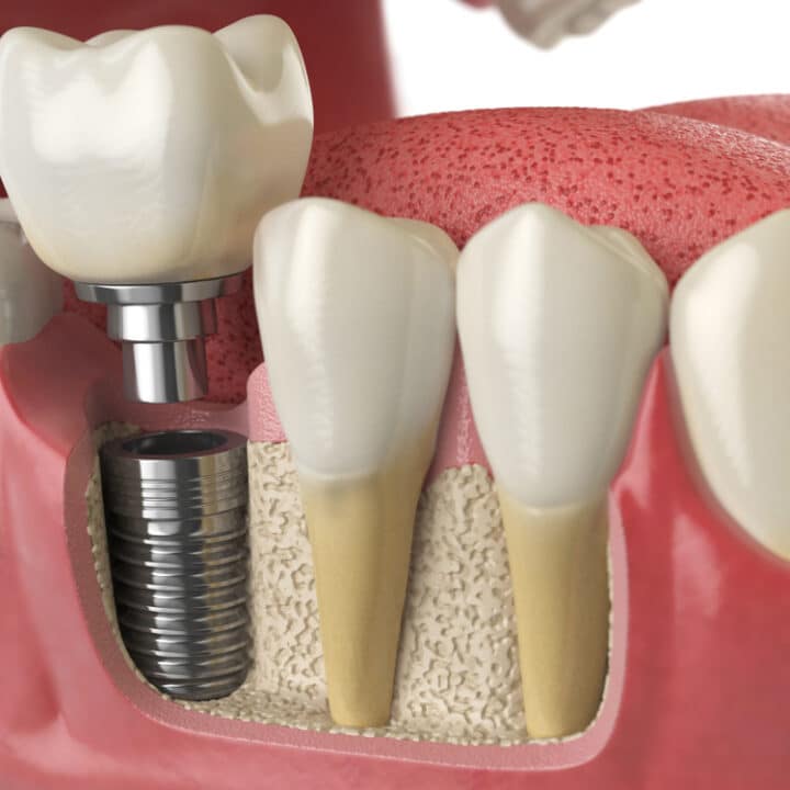 Closer Look Of A Dental Implant