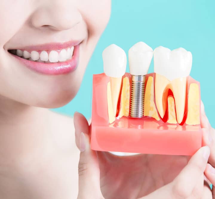 Woman Holds A Tooth With A Dental Implant